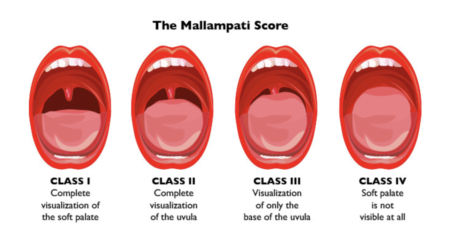 Mallampatti Classification
